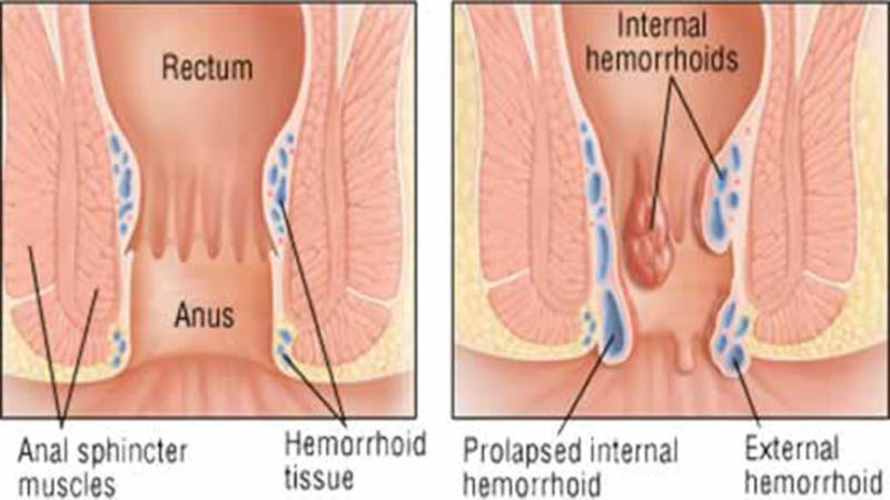 Anatomy hemorrhoids